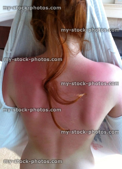 Stock image of sunburnt back of a red haired, pale skin girl