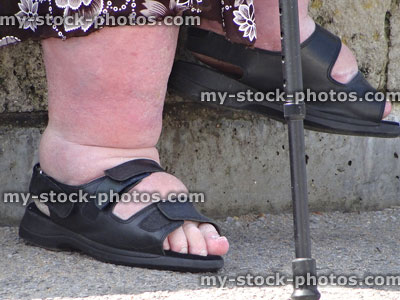 Stock image of old lady wearing sandals with swollen ankles / cankles